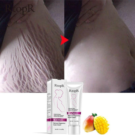 Mango Stretch Mark Skin Repair Cream